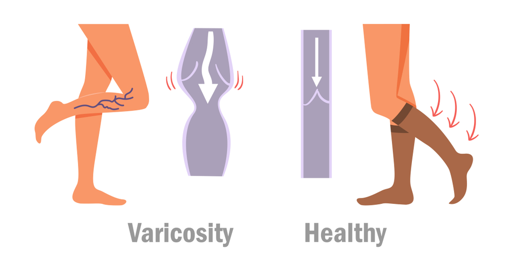 The benefits of wearing Compression Stockings